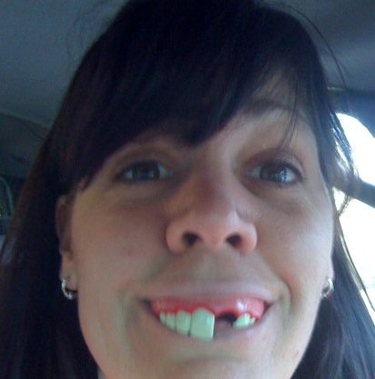 Woman With Half Broken Teeth