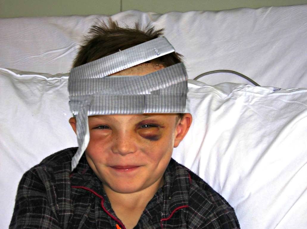 Funny Duct Tape Using As Bandages For Head Injury