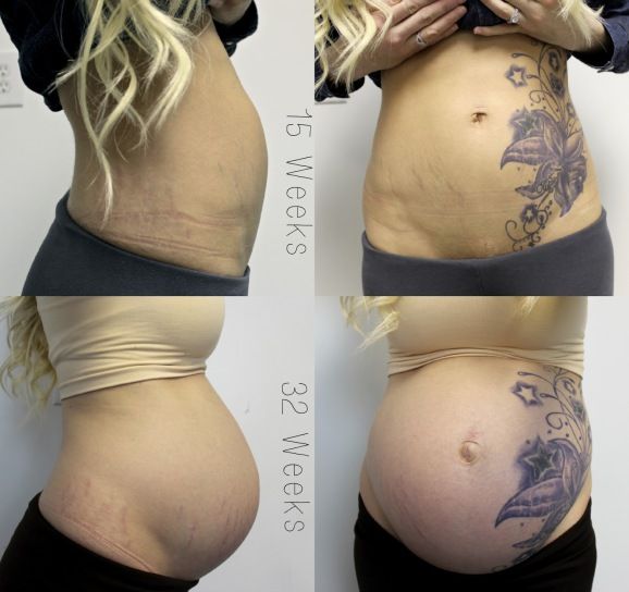 Flower With Stars Tattoo On After Pregnancy Belly
