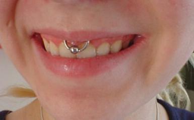 Beautiful Smiley Lip Frenulum Piercing