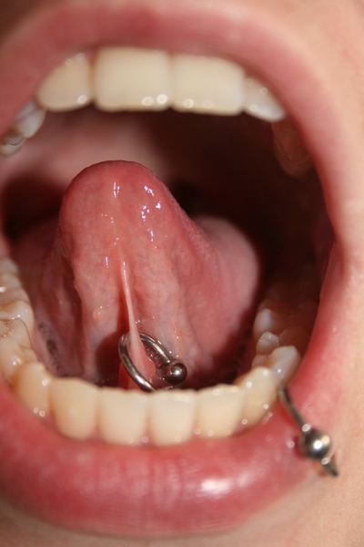 Lip And Tongue Frenulum Piercing With Bead Ring