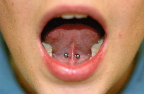 Lingual Frenulum Piercing With Barbell