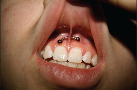 Lingual Frenulum Piercing With Curved Barbell