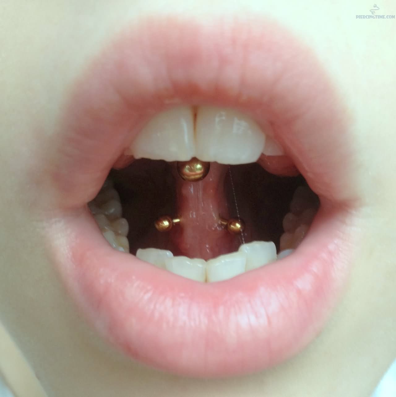 Lingual Frenulum Piercing With Gold Barbell