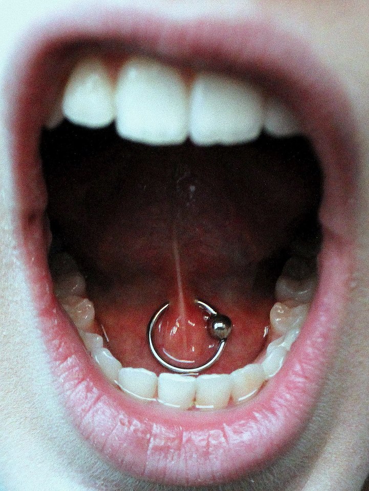 Lingual Frenulum Piercing With Silver Bead Ring