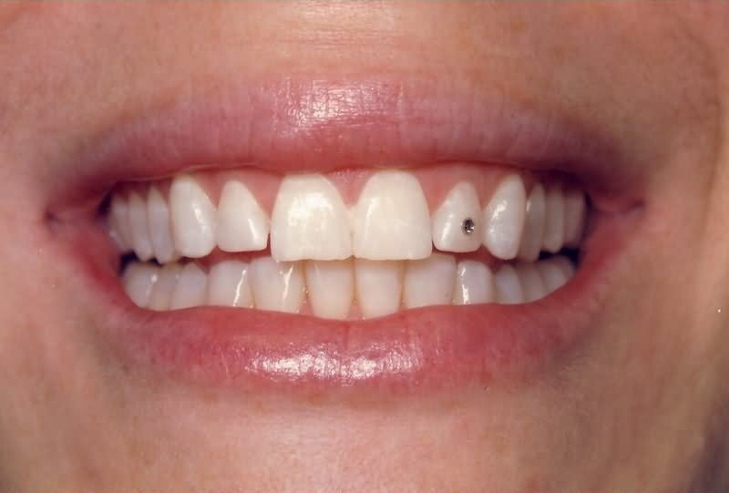 Tooth Piercing Closeup Image
