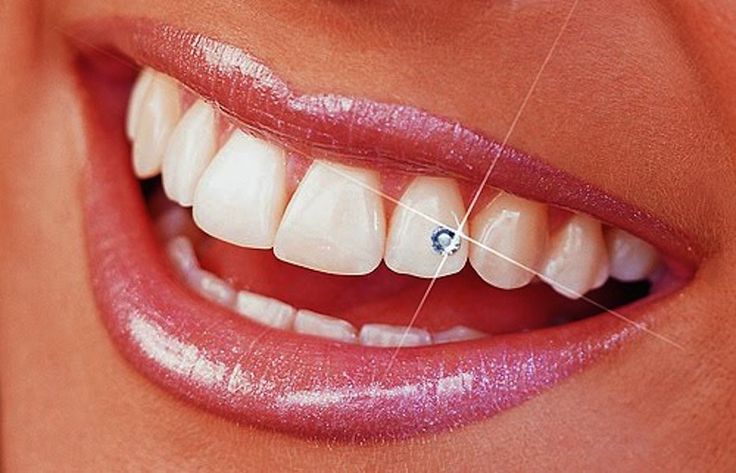 Tooth Piercing With Shining Diamond Jewel