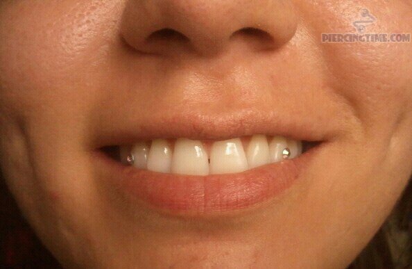 Tooth Piercing With Silver Jewels