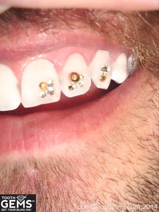 Tooth Piercings With Diamond Jewels