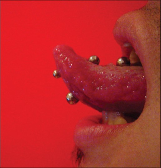 Multiple Tongue Piercings With Barbells