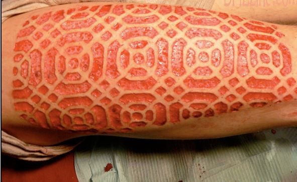 Amazing Pattern Skin Scarification Tattoo On Forearm