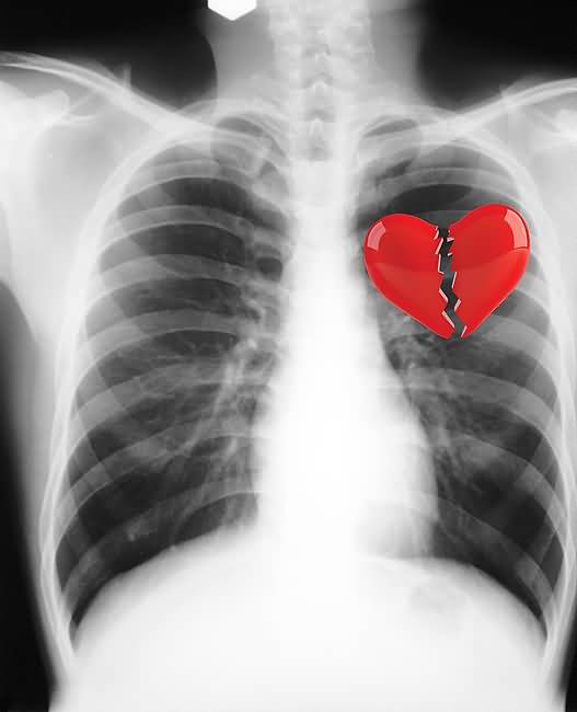 Broken Heart X-ray