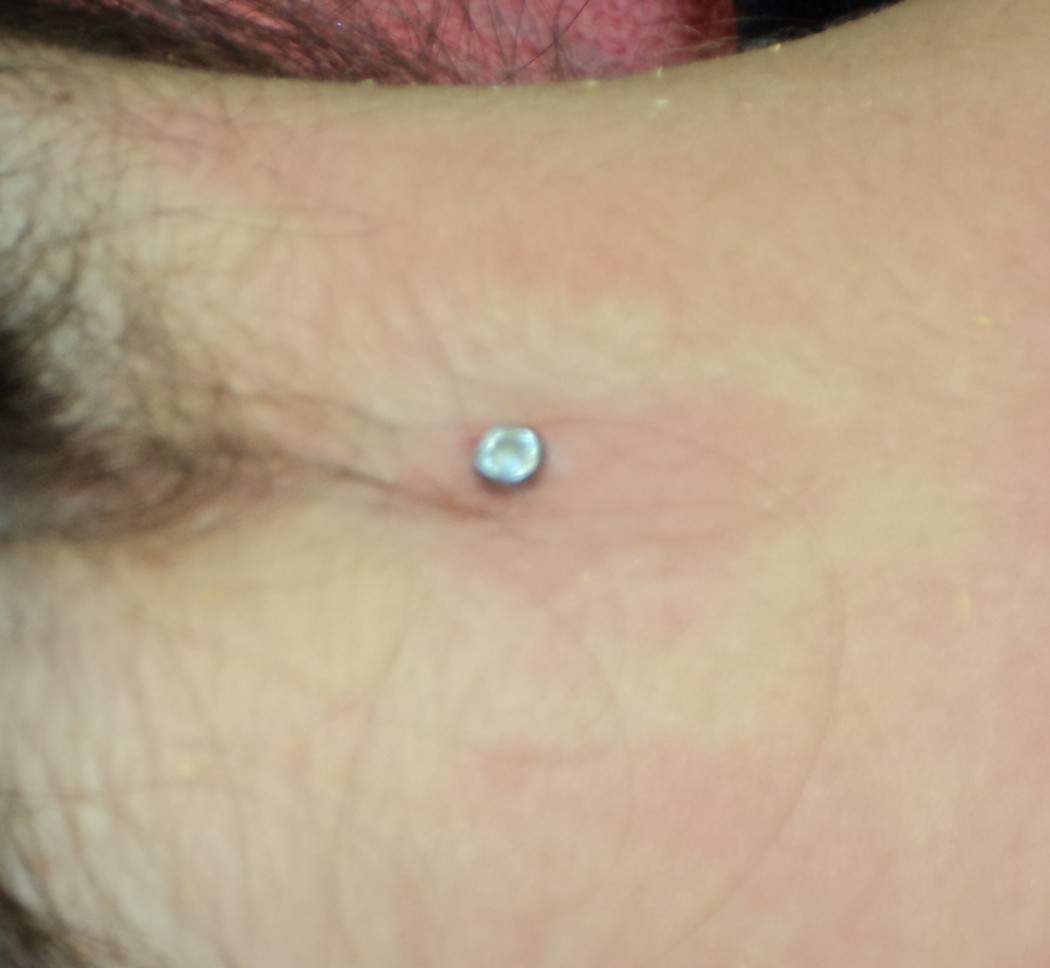 Dermal Anchoring Piercing For Young Girls