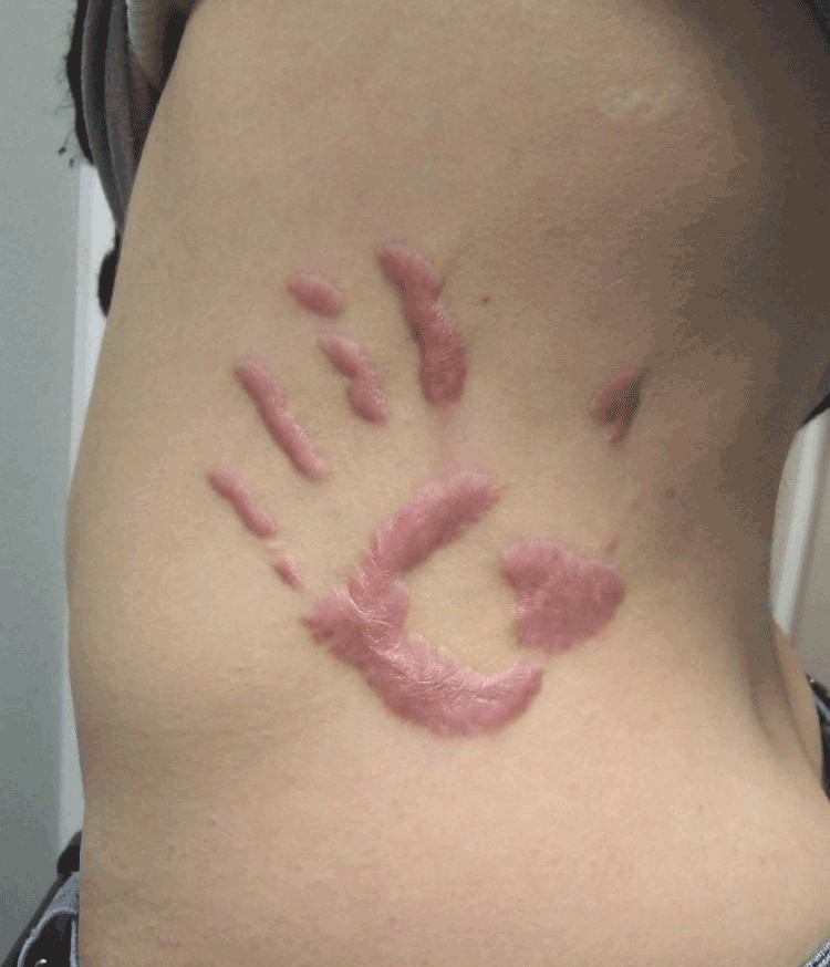Healed Hand Print Scarification Tattoo On Side Rib