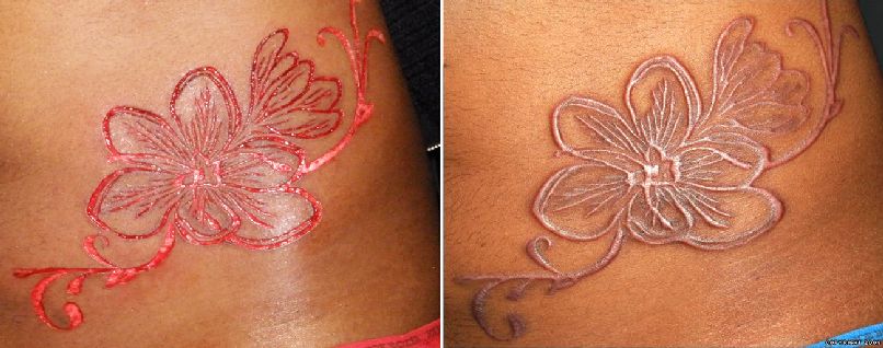 Hibiscus Flower Before And After Scarification Tattoo