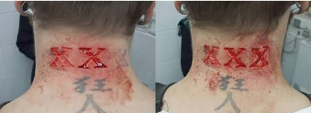 X Scarification Tattoo On Back Neck