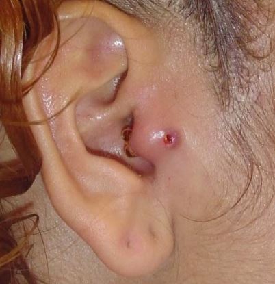 fogyáshoz kapcsolódó tragus piercing)