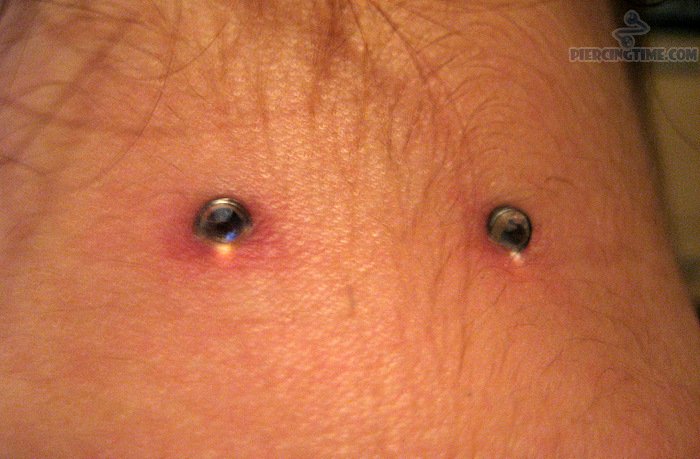 Back Neck Surface Piercing With Dermals
