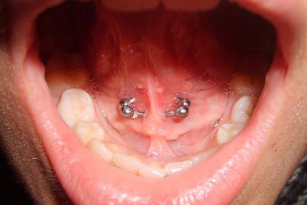 Double Tongue Frenulum Piercing With Silver Barbells