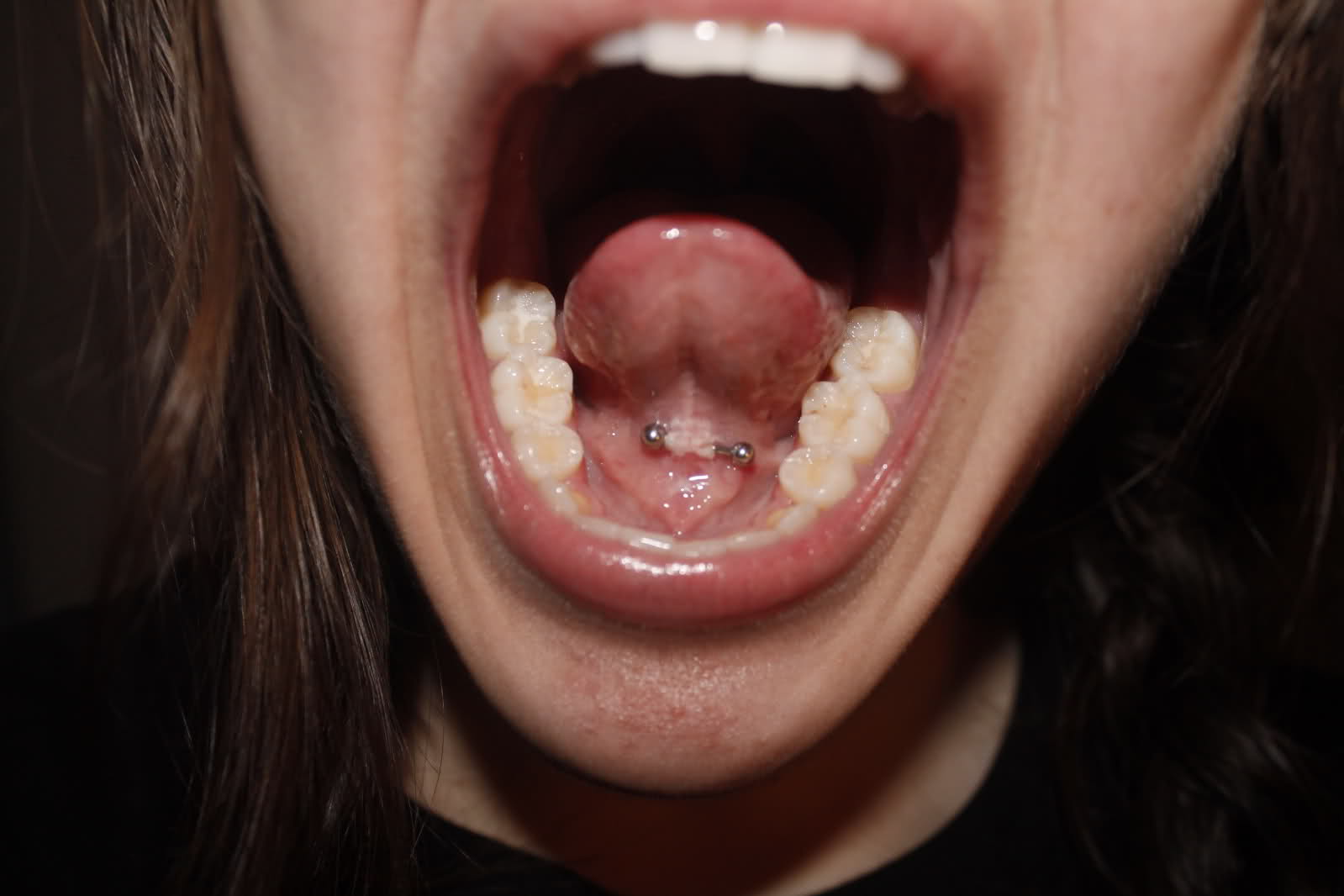 Frenelum Tongue