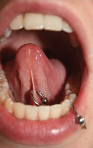 Lower Lip and Tongue Frenulum Piercings With Bead Rings