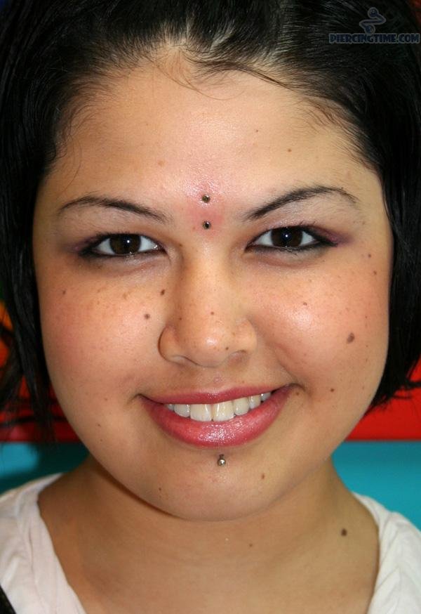 Surface Bridge With Dermal Anchors