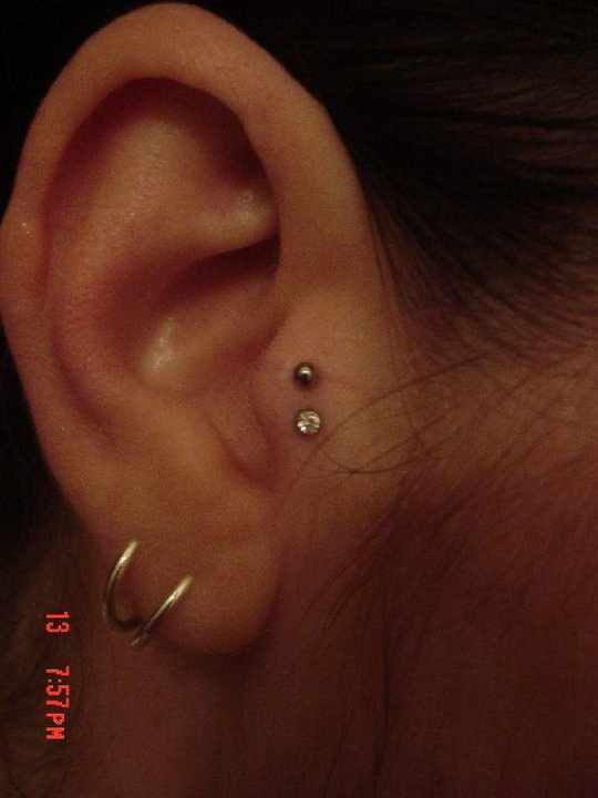 Surface Ear Piercing With Stud And Dermal Anchor