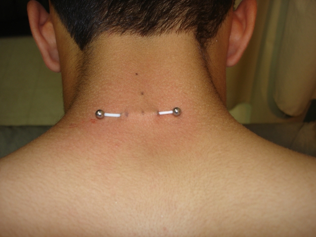 Back Neck Piercing With Large Surface Barbell