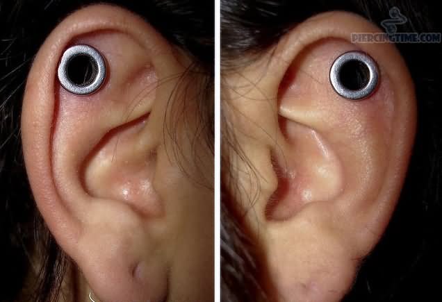 Cartilage Dermal Punch On Left Ear