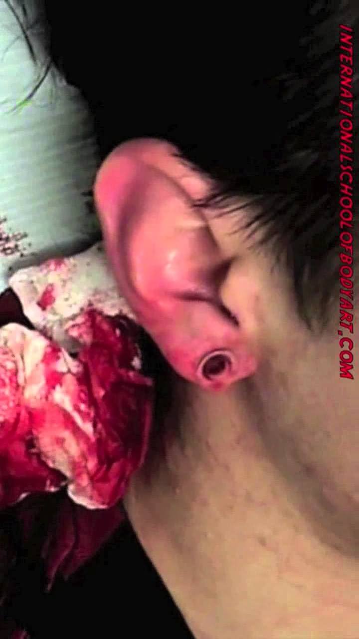 Dermal Punch Right Ear Piercing