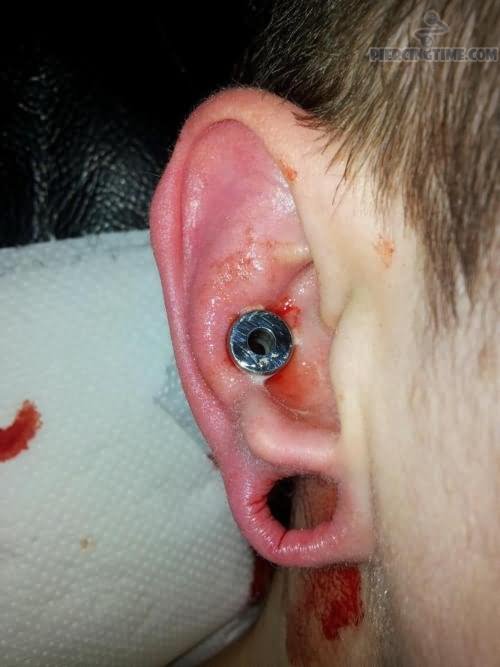 Dermal Punched Ear Piercing
