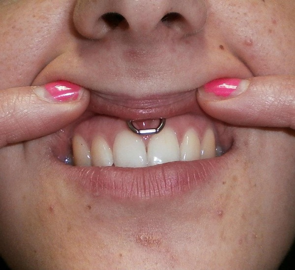 Girl Showing Her Smiley Piercing