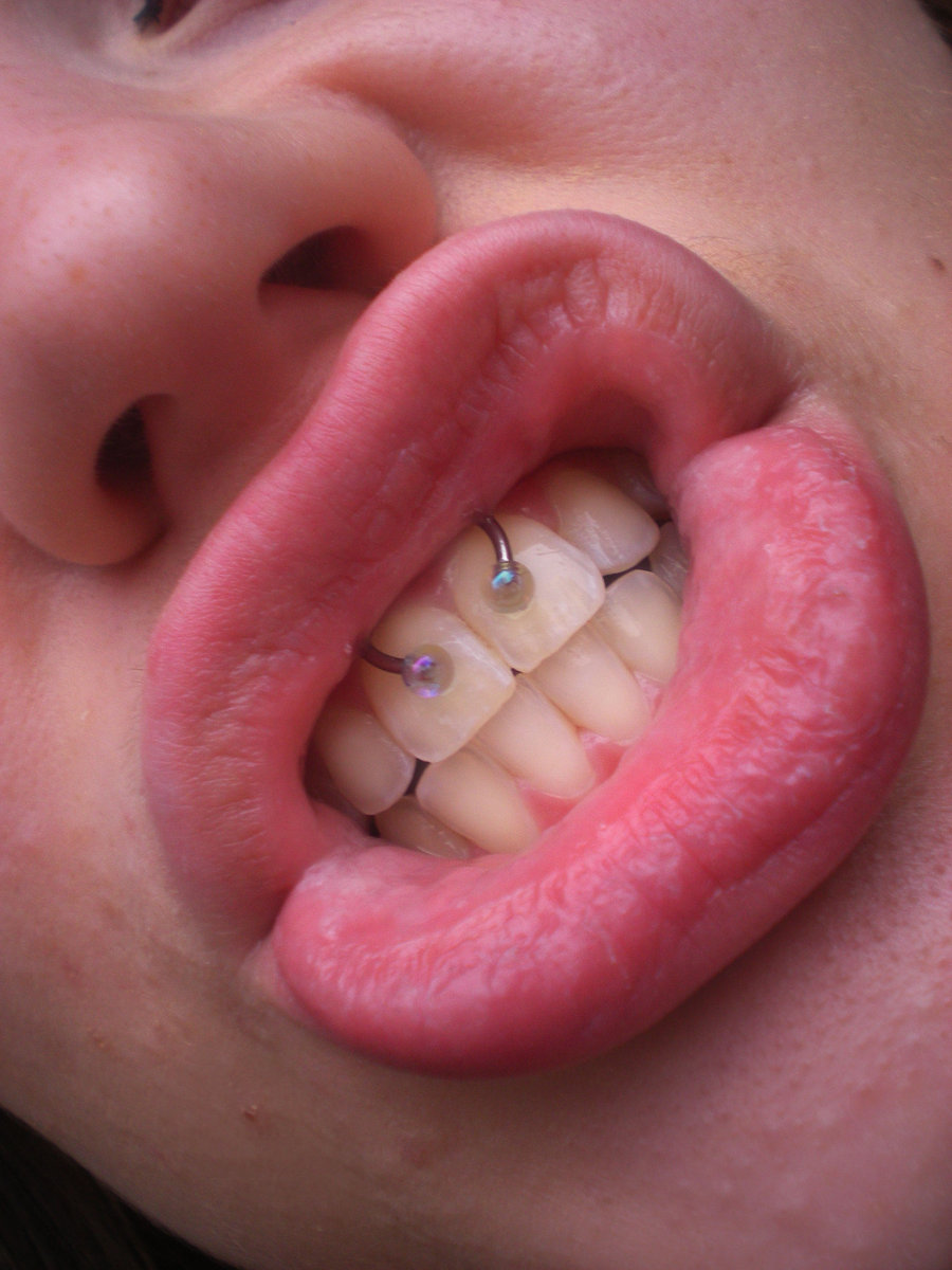 Girl Showing Her Upper Lip Smiley Piercing