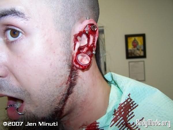 Man Left Ear Dermal Punch Piercing