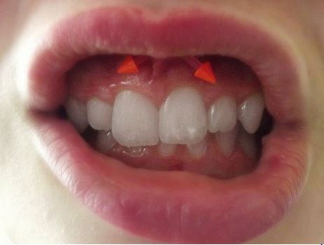 Smiley Piercing With Orange Spike Barbell