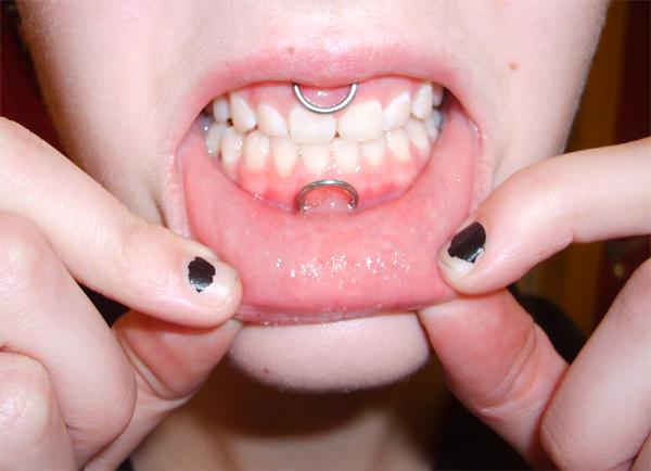 Lower Lip And Smiley Hoop Piercing