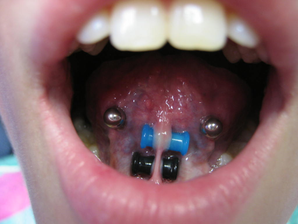 Tongue Piercing And Webbing Piercing With Gauges