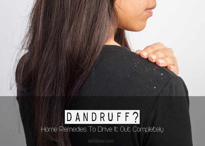 Dandruff? Home Remedies To Drive It Out Completely